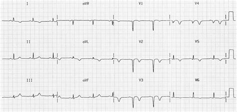 prwp ecg